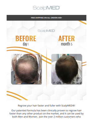 Faster & Fuller Hair Regrowth By ScalpMED®