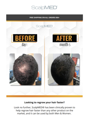 REGROW Your Hair Faster With ScalpMED®