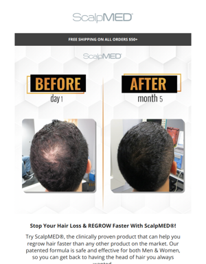 Stop Your Hair Loss & REGROW Faster With ScalpMED®!